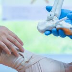 перелом пятки реабилитация